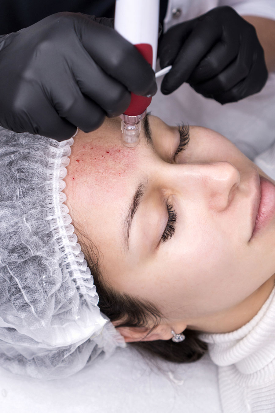 SkinPen Microneedling